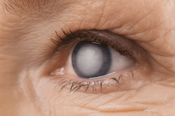 Cirurgia de Catarata em Campinas