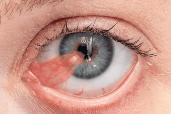 Cirurgia de Pterígio em Campinas