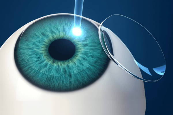 Cirurgia Refrativa Lasik em Campinas