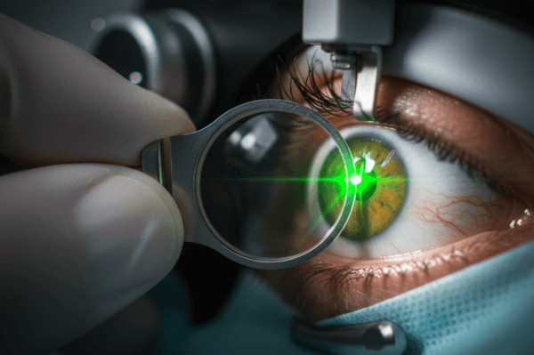 YAG laser (capsulotomia) em Campinas